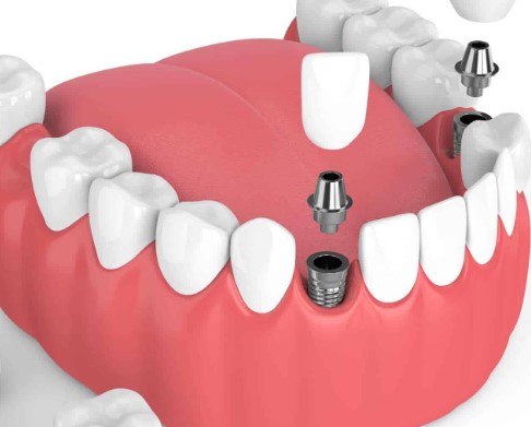 Dental Implants Vs Dentures Choosing The Right Tooth Replacement, Dental Implants or Dentures, Tooth Restoration Options, Dental Solutions for Missing Teeth, Tooth Replacement Alternatives, Dental Prosthesis Comparison, Deciding Between Dental Implants and Dentures, Optimal Tooth Restoration Methods, Dental Devices for Missing Teeth, Selecting the Best Tooth Replacement, Dental Implants vs Removable Dentures, Dental Treatment for Tooth Loss, Comparing Dental Implants and Dentures, Tooth Replacement DecisionMaking, Dental Prosthodontics Options, Making the Right Tooth Restoration Choice, Dental Implantology vs Denture Solutions, Dental Bridge or Denture Which is Better, Dental Prosthetics for Missing Teeth, Evaluating Dental Implants vs Dentures, Dental Restoration for Missing Teeth, Dental Implants and Dentures Comparison, Finding the Ideal Tooth Replacement Option, Dental Implant Surgery vs Denture Fitting